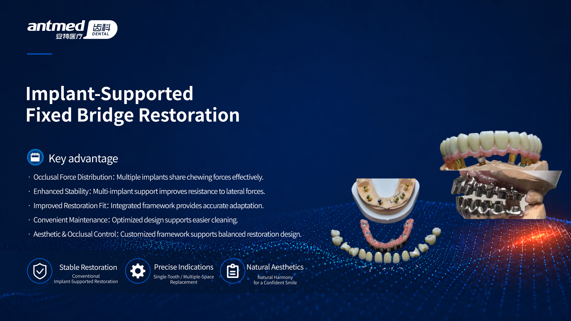 Implant-Supported Fixed Bridge Restoration